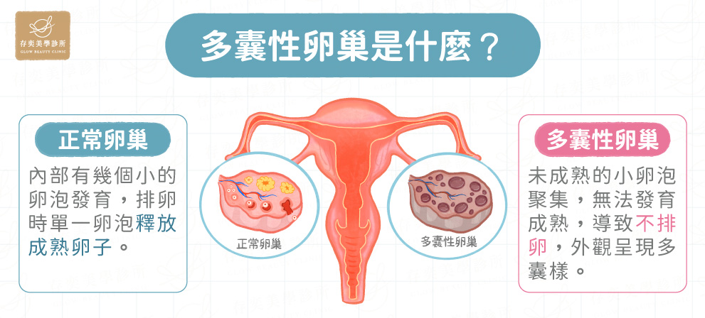 多囊性卵巢是什麼V2