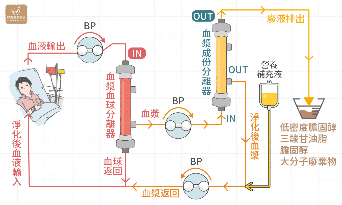 血液淨化 (血漿置換術)原理