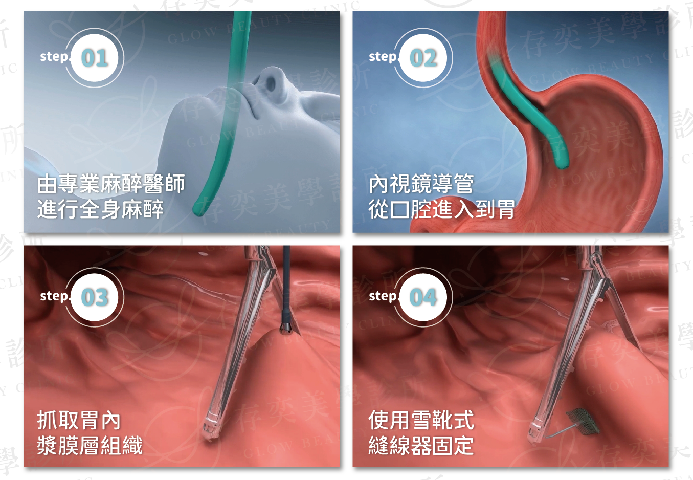 胃縫合手術過程1