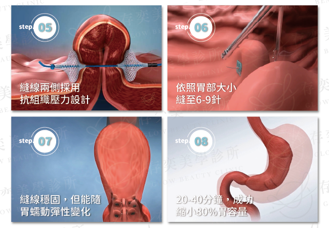 胃縫合手術過程2