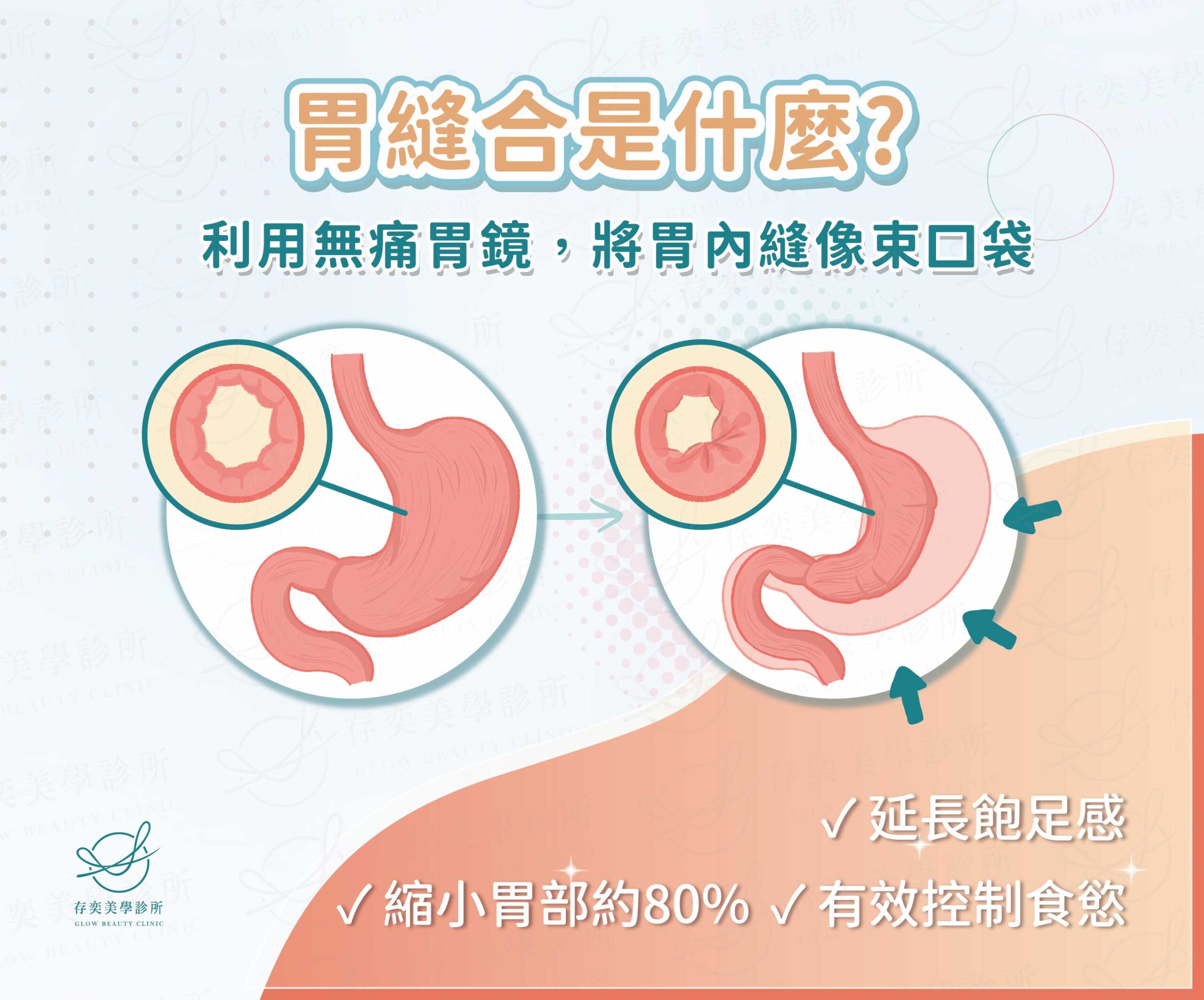 胃縫合是什麼_0