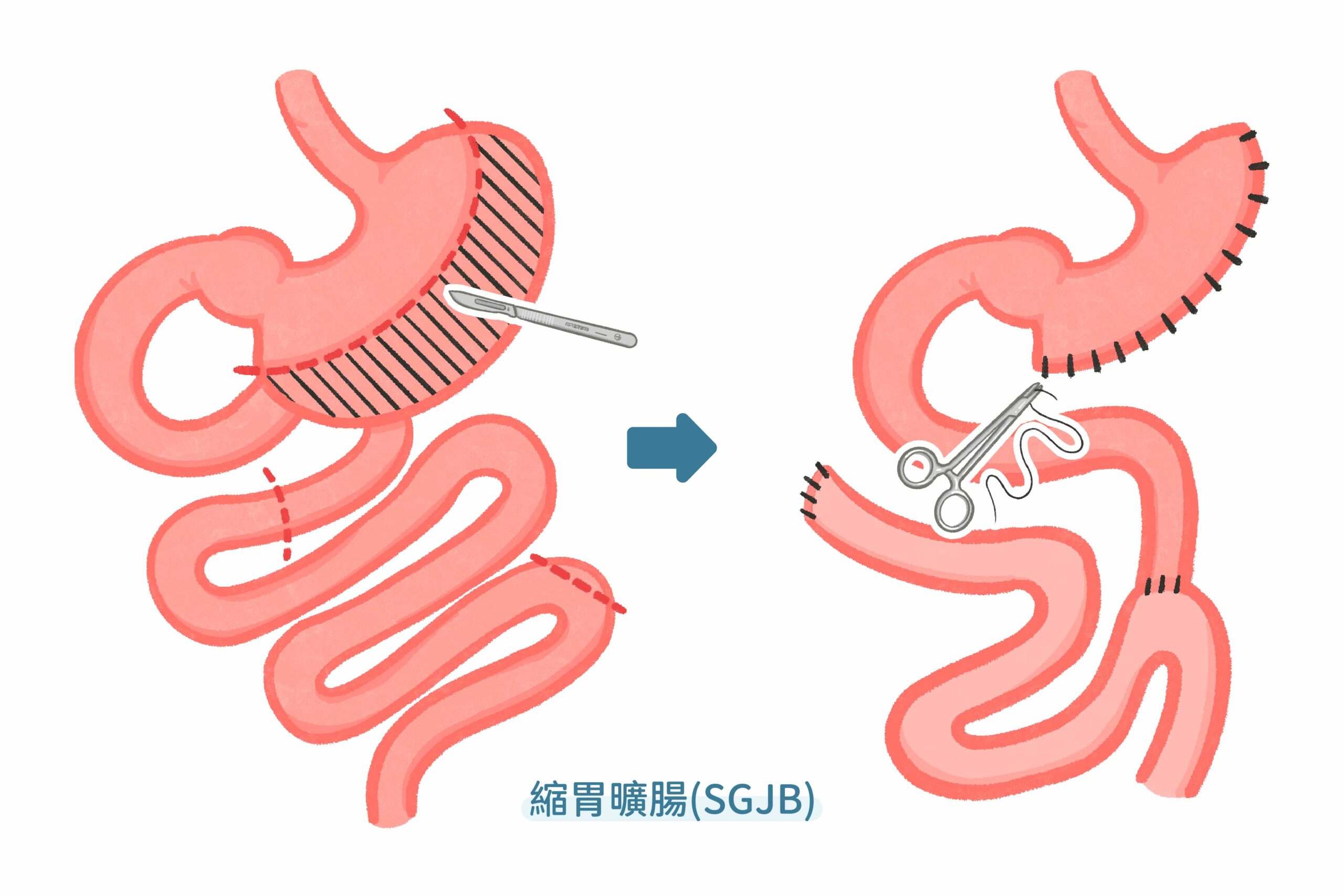 縮胃曠腸SGJB