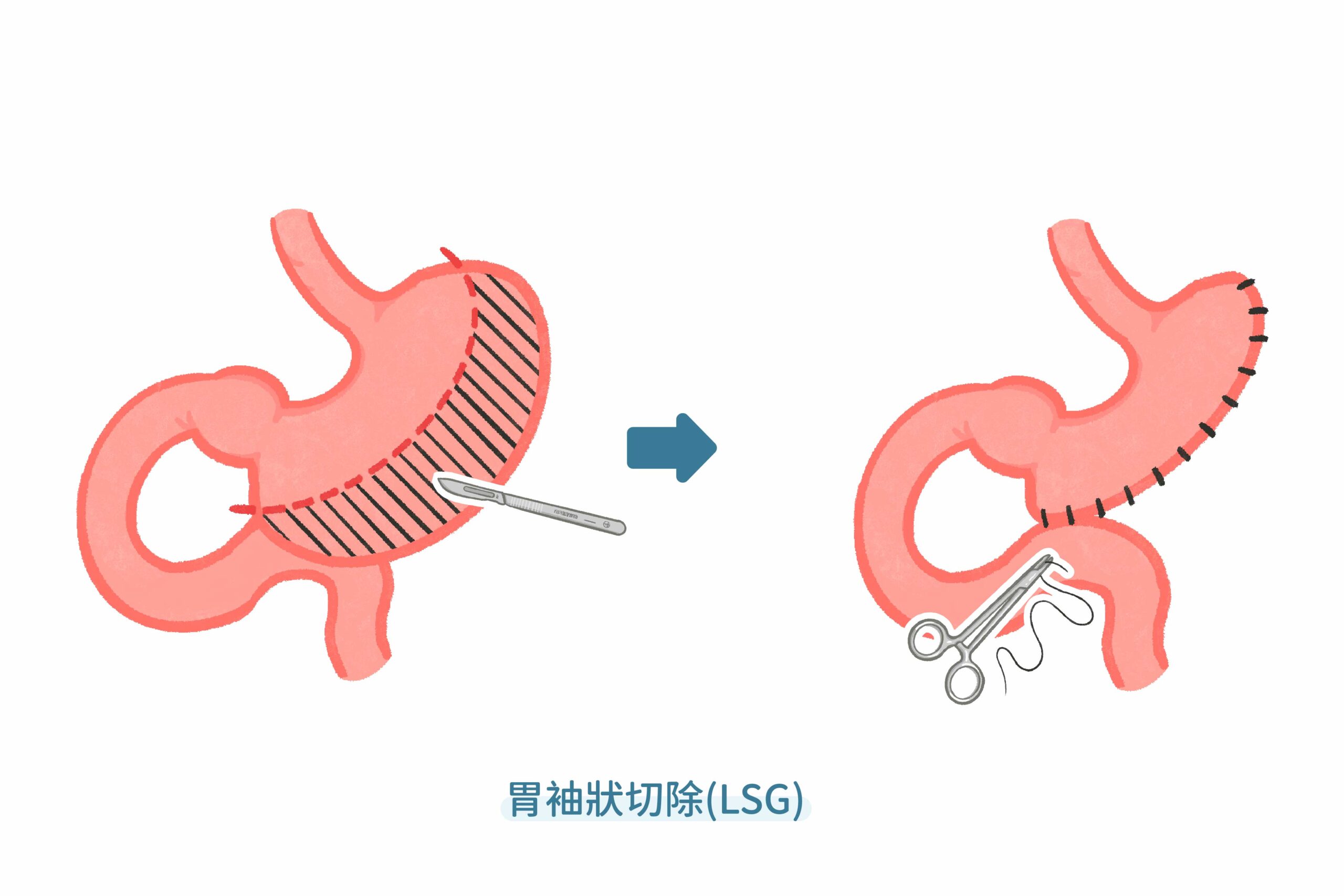 胃袖狀切除LSG