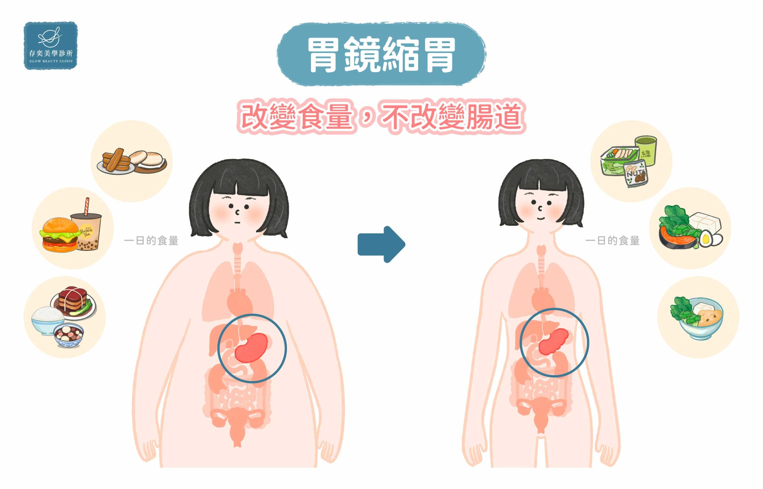 胃鏡縮胃-改變食量,不改變腸道