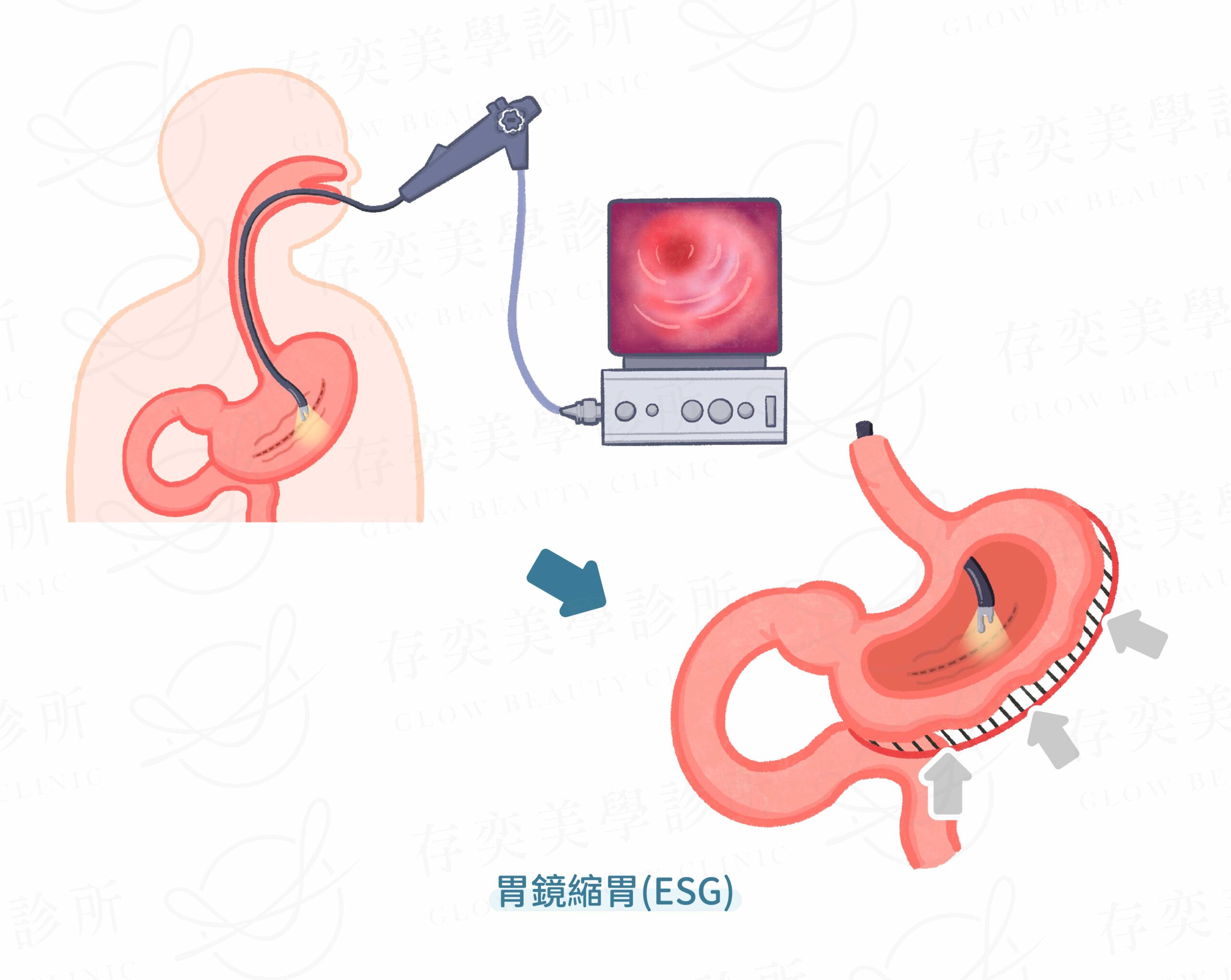 胃鏡縮胃ESG-02