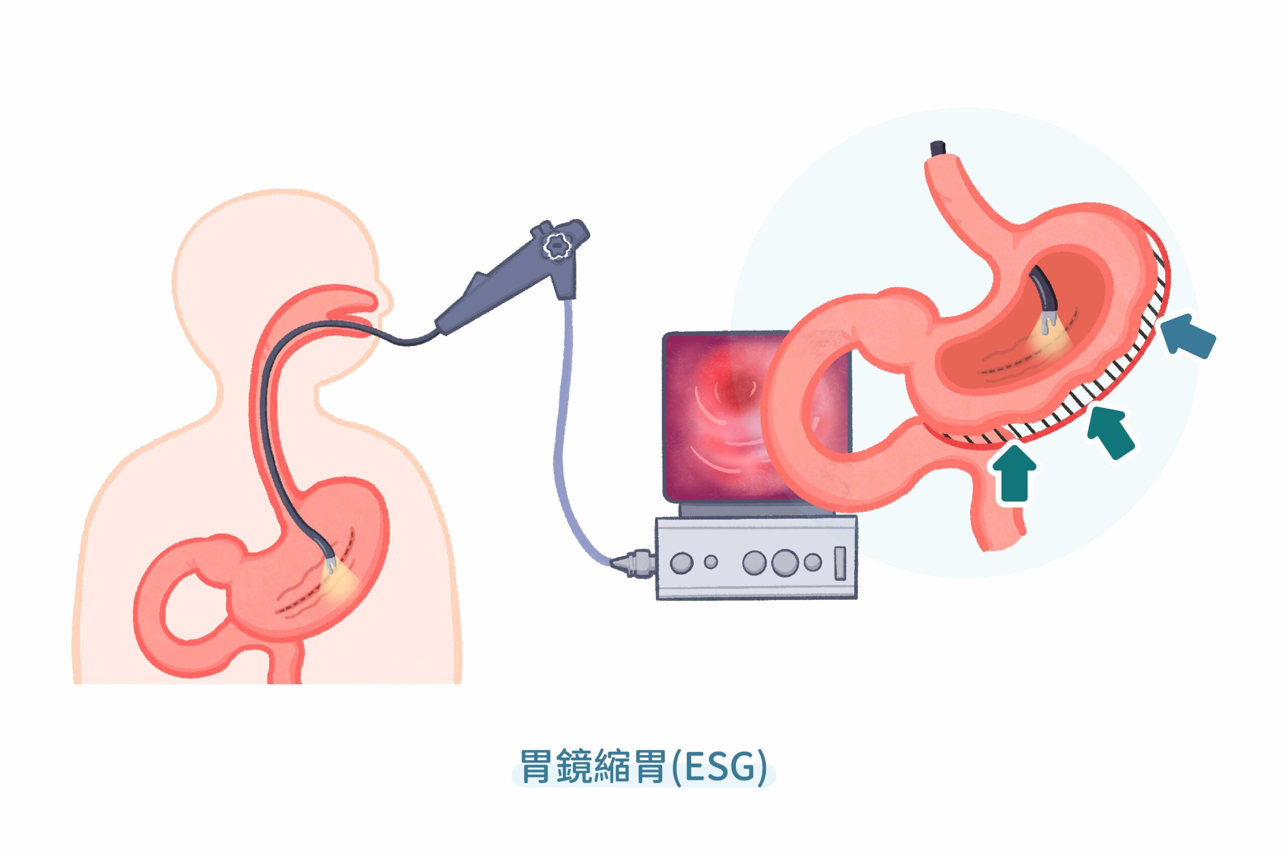 胃鏡縮胃ESG-02