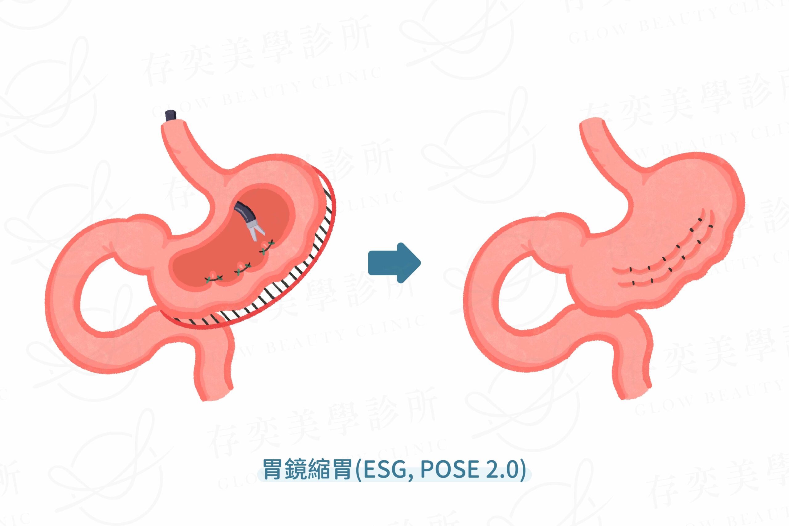 胃鏡縮胃ESG,POSE2.0