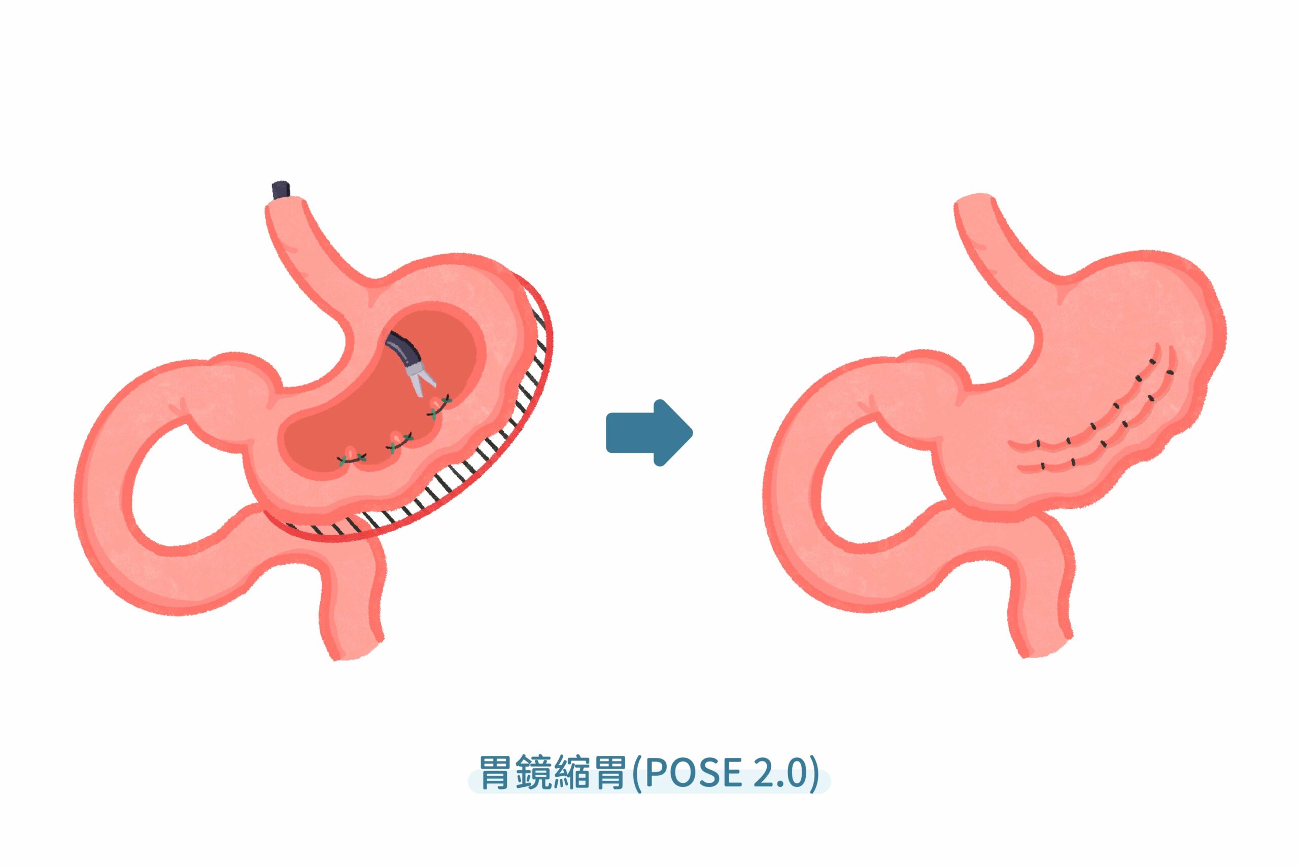 胃鏡縮胃POSE2.0