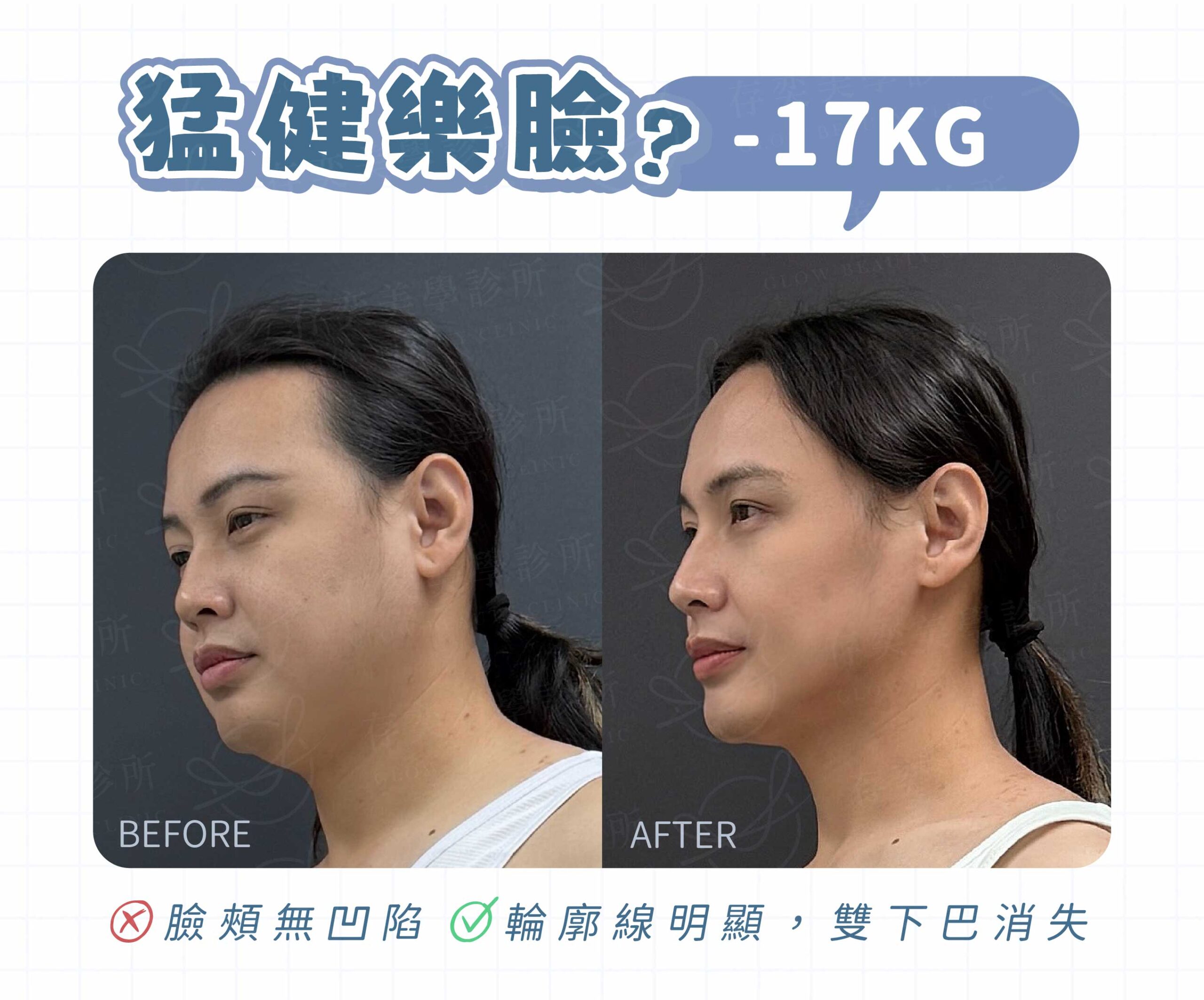 猛健樂臉案例-01