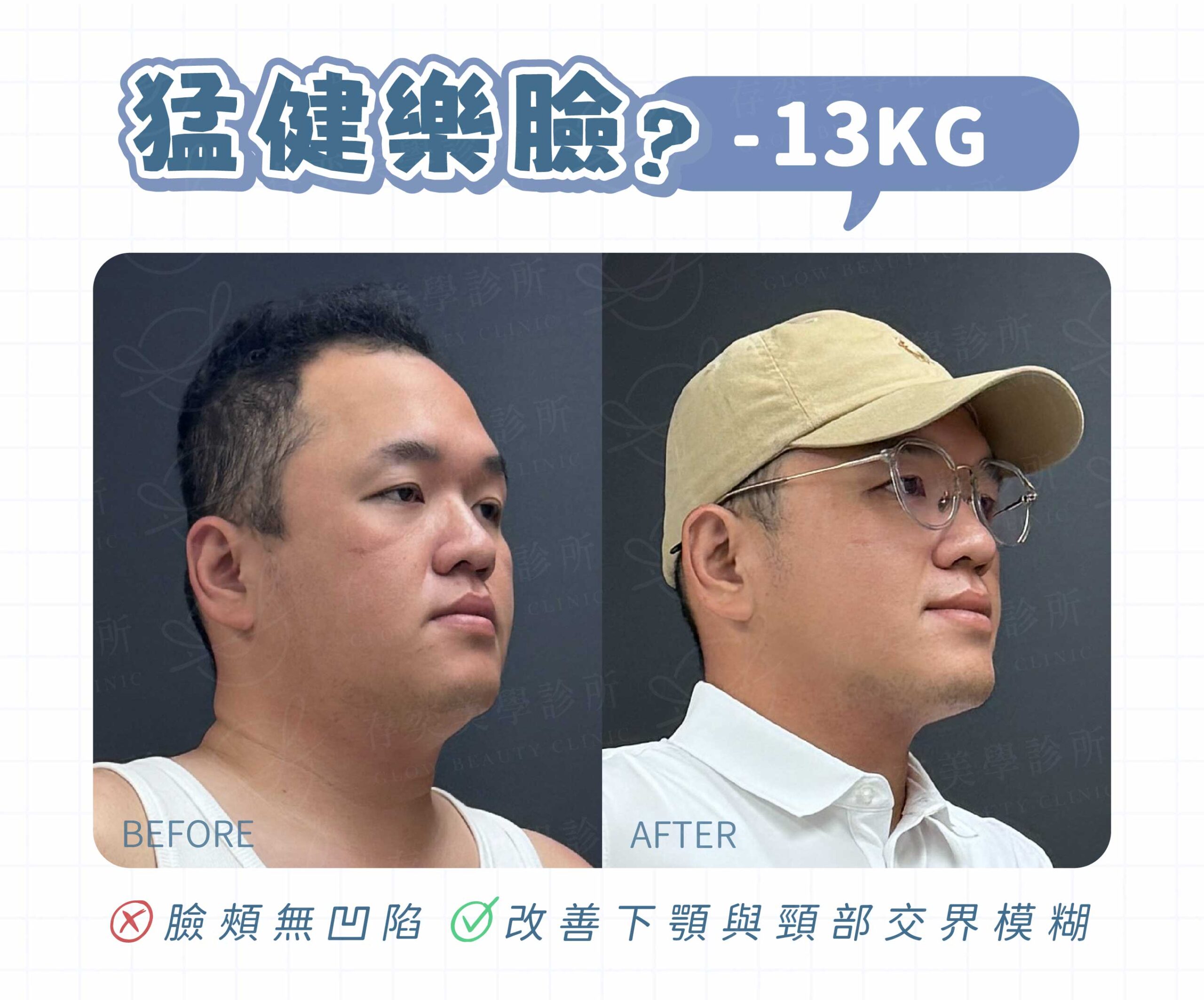 猛健樂臉案例-02