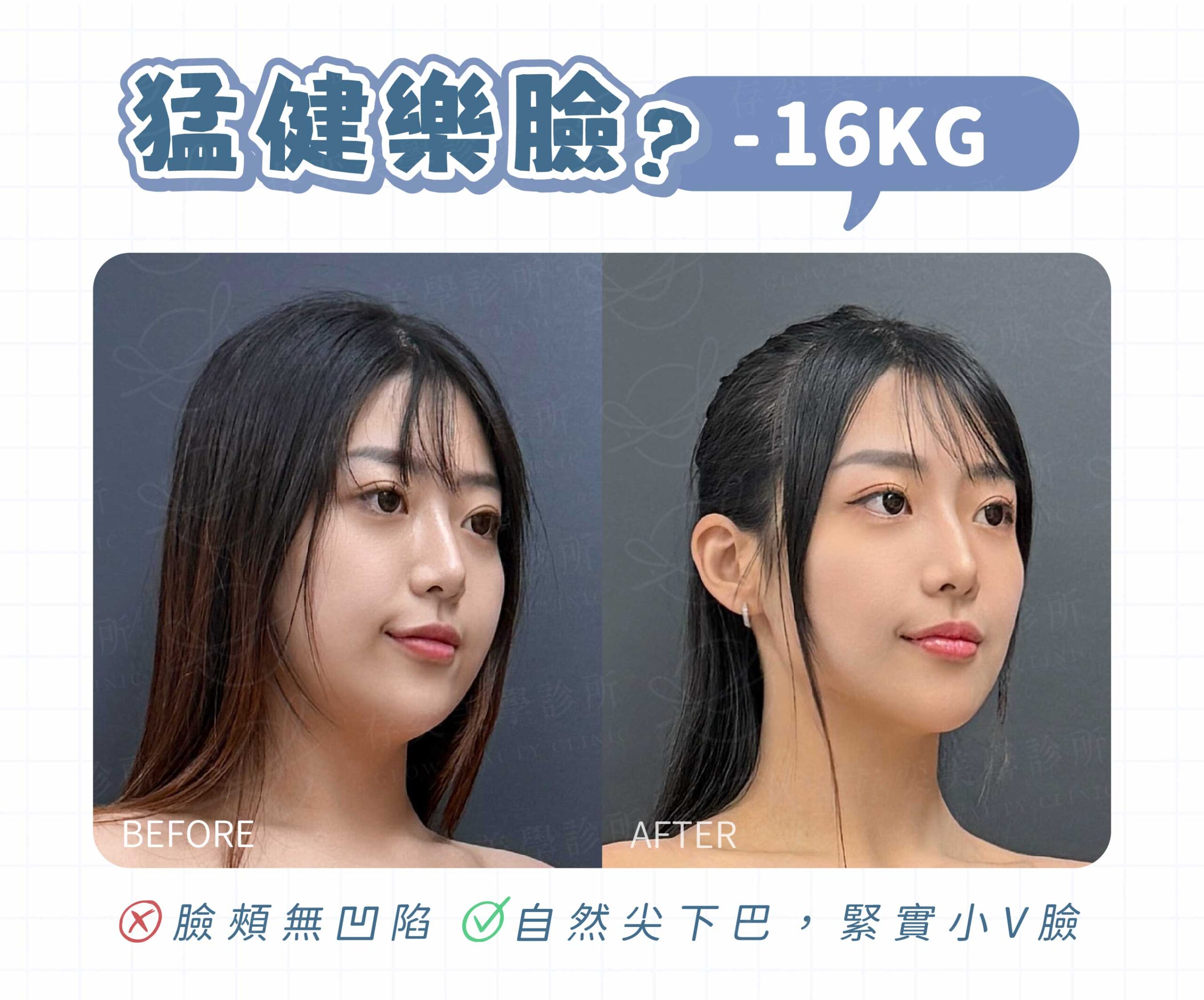 猛健樂臉案例-04