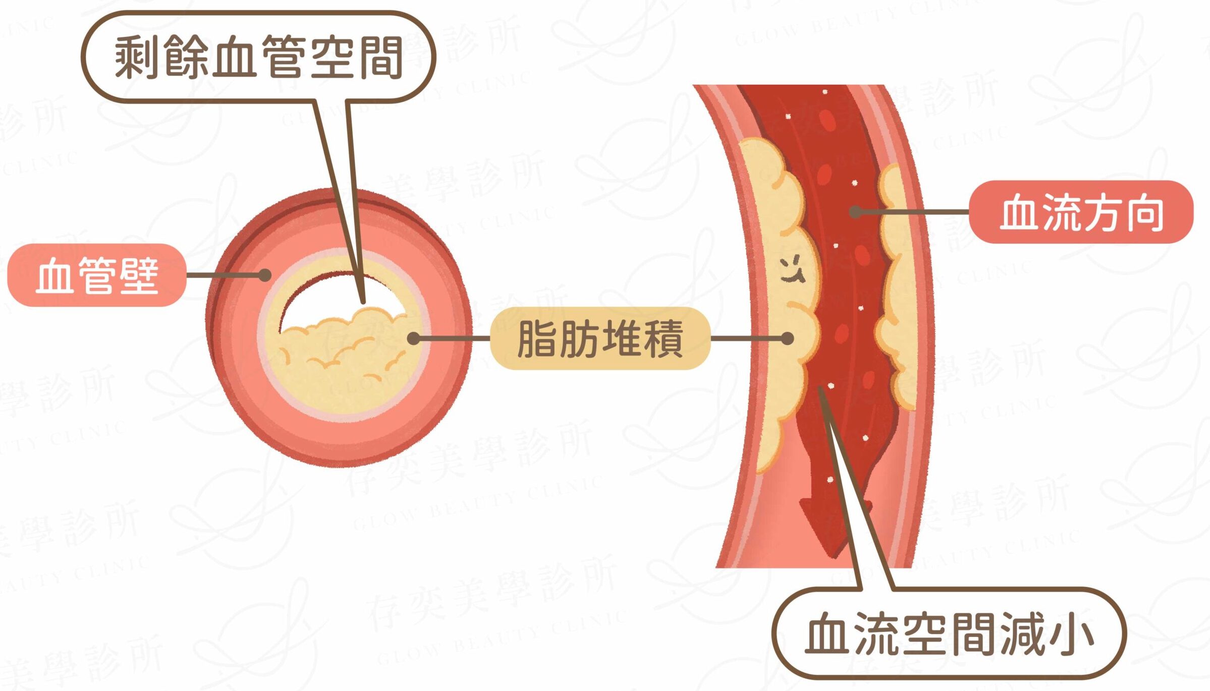 血管不順，心臟最痛苦_血管堵塞
