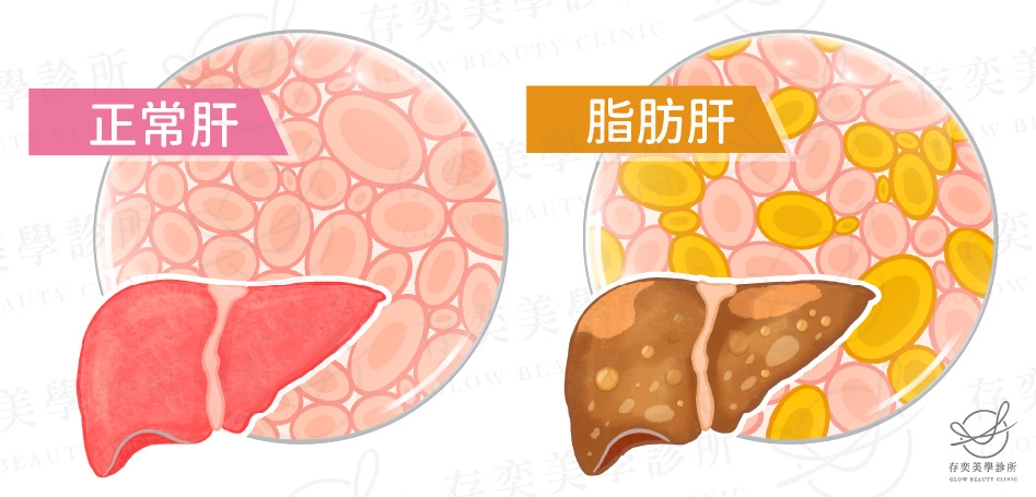 正常肝臟與脂肪肝v4