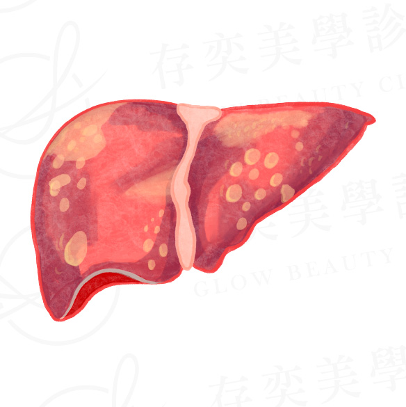 脂肪肝會不會變肝癌_發炎與肝細胞損傷