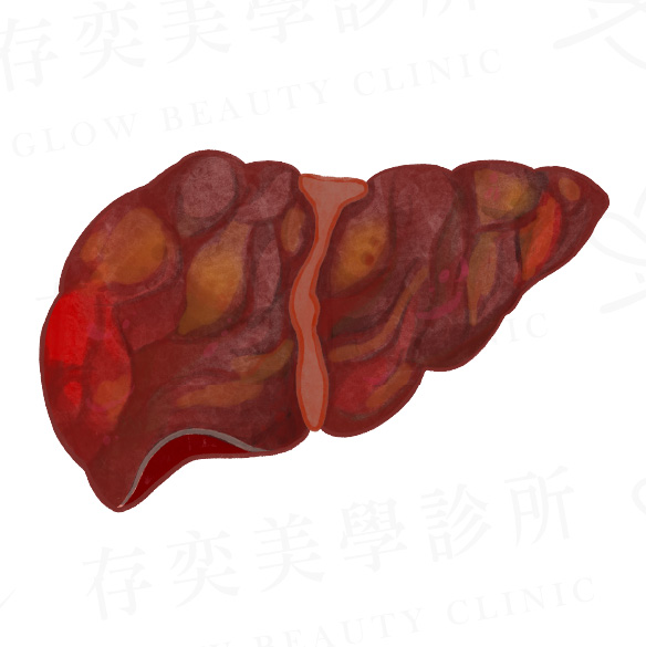 脂肪肝會不會變肝癌_肝細胞癌