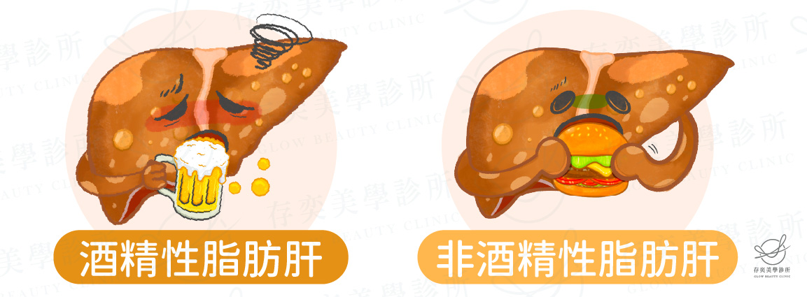 酒精性與非酒精性脂肪肝v4