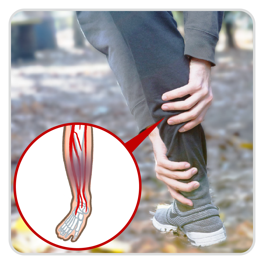 血管堵塞在哪_下肢→歇性跛行