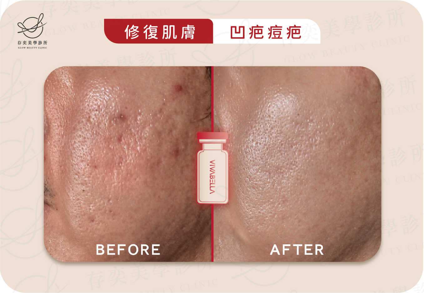 薇貝拉VIVABELLA術前術後_修復肌膚_凹疤痘疤
