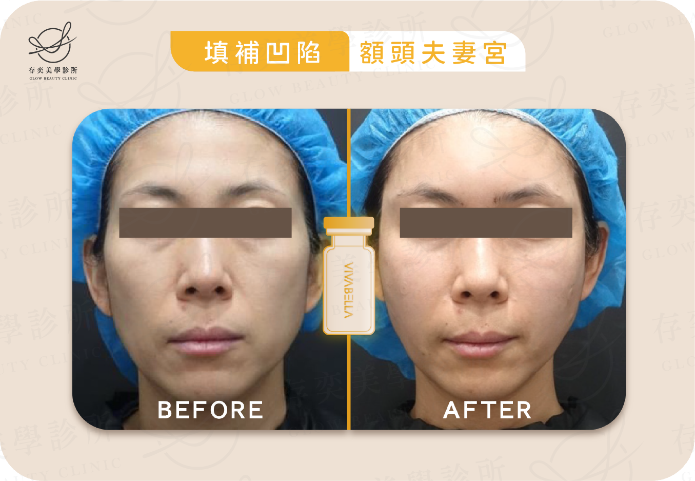 薇貝拉VIVABELLA術前術後_填補凹陷_額頭夫妻宮