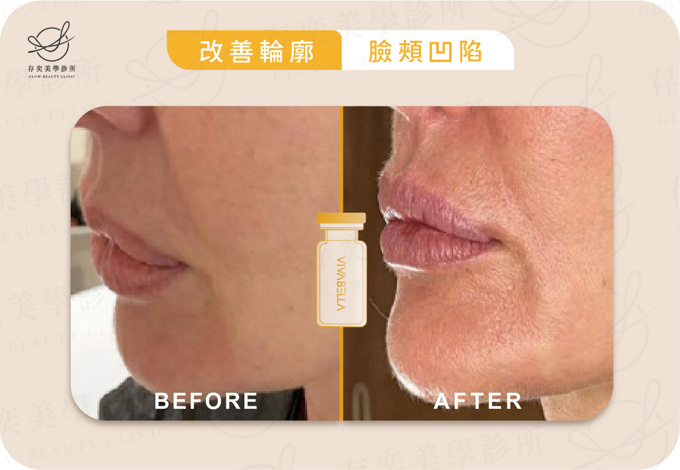 薇貝拉VIVABELLA術前術後_大分子改善臉部輪廓