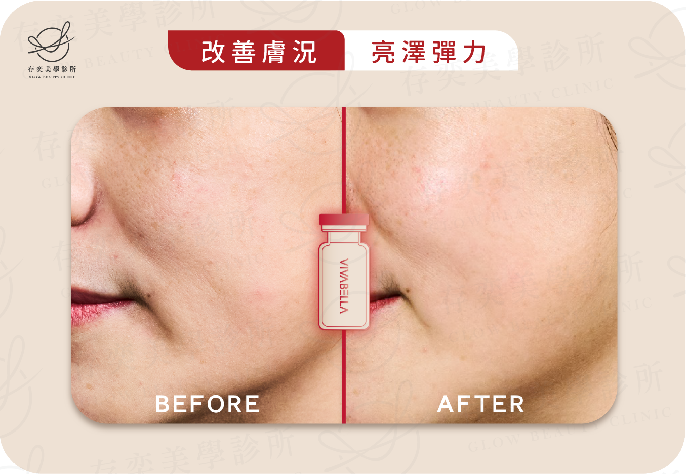 薇貝拉VIVABELLA術前術後_改善膚況_亮澤彈力