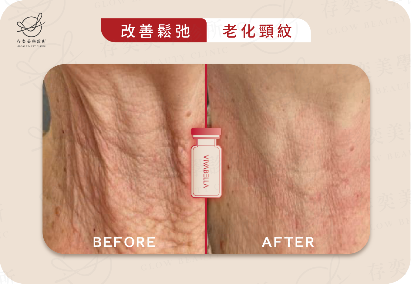 薇貝拉VIVABELLA術前術後_改善鬆弛_老化頸紋