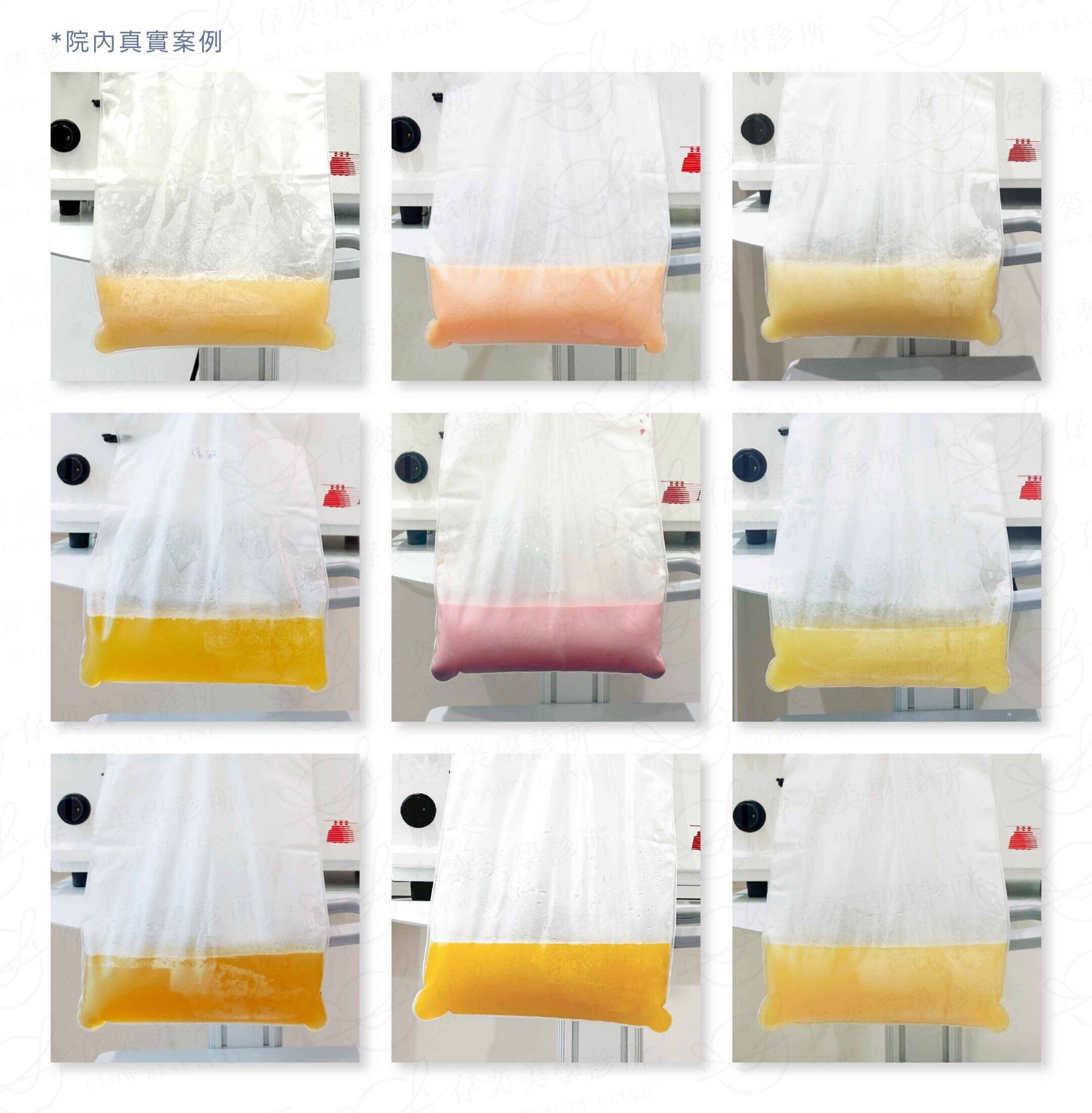 眾多血液淨化案例