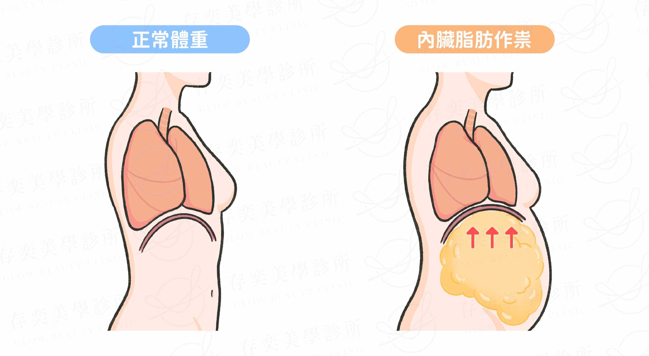 內臟脂肪作祟,肺部空間變小