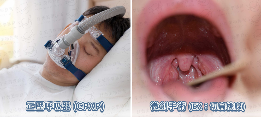 猛健樂改善睡眠呼吸中止症