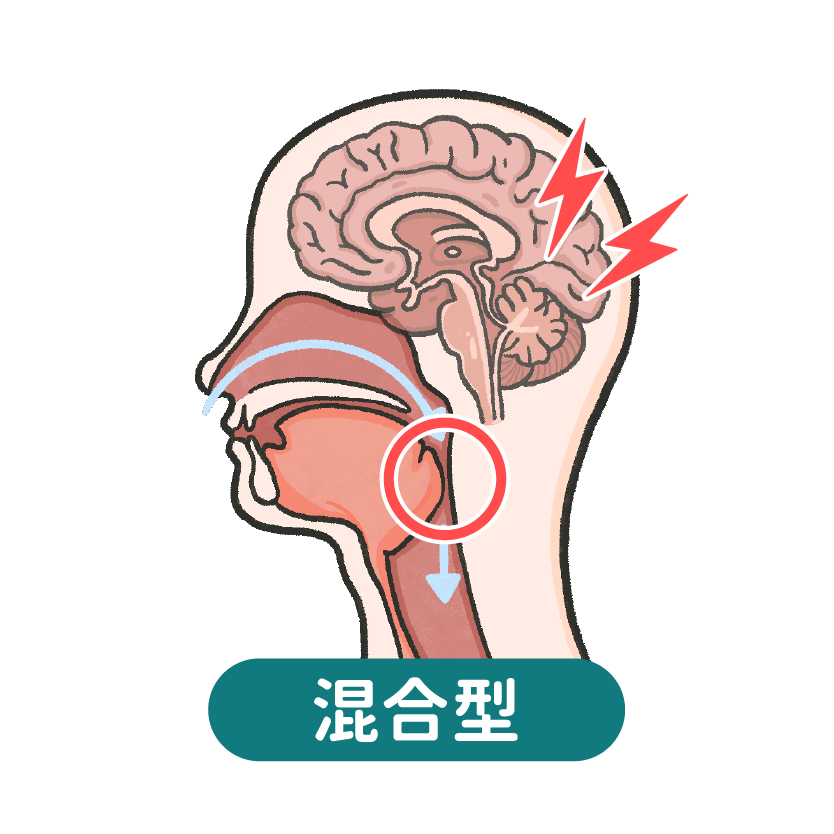 猛健樂改善睡眠呼吸中止症睡眠呼吸中止症_混合型