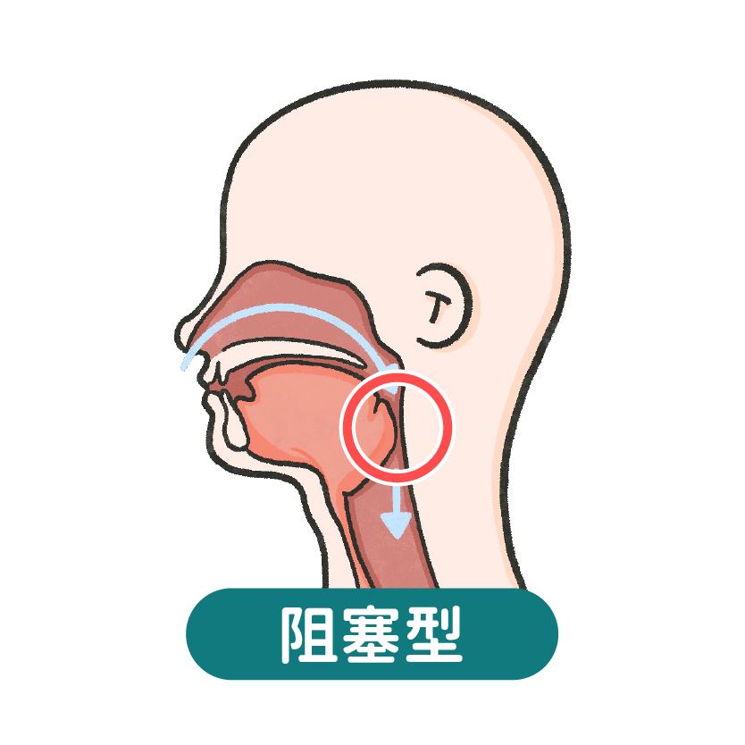 猛健樂改善睡眠呼吸中止症睡眠呼吸中止症_阻塞型