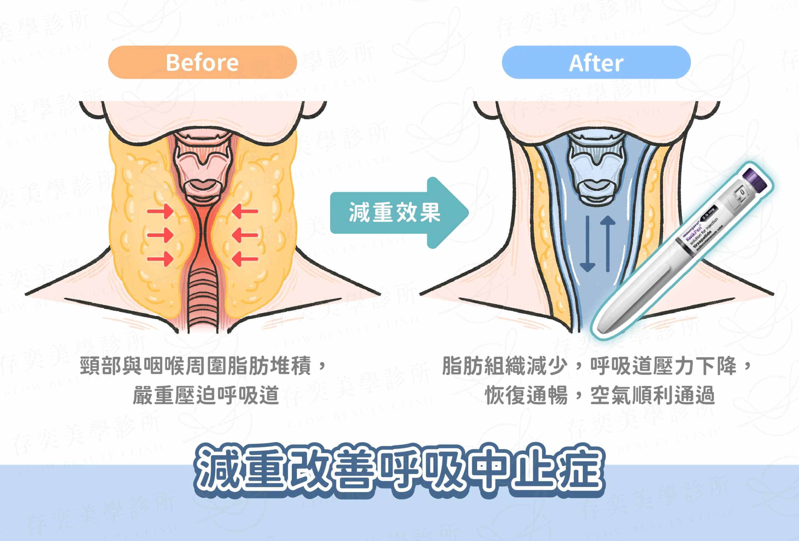 猛健樂改善睡眠呼吸中止症