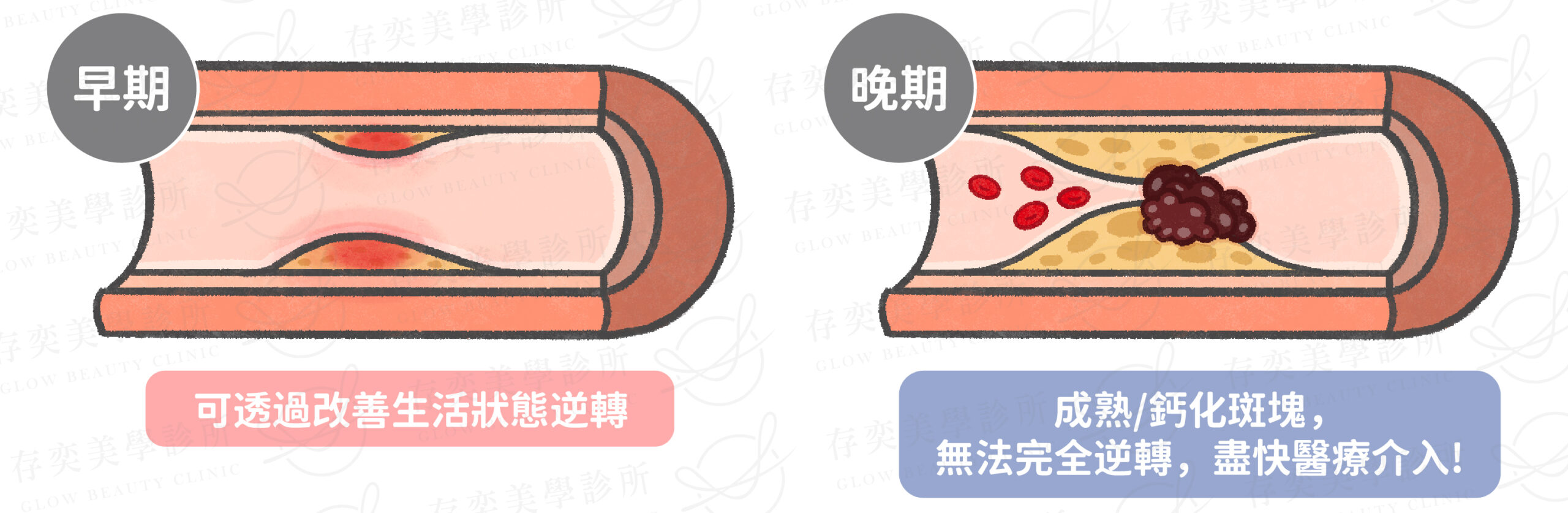 血管硬化可逆嗎