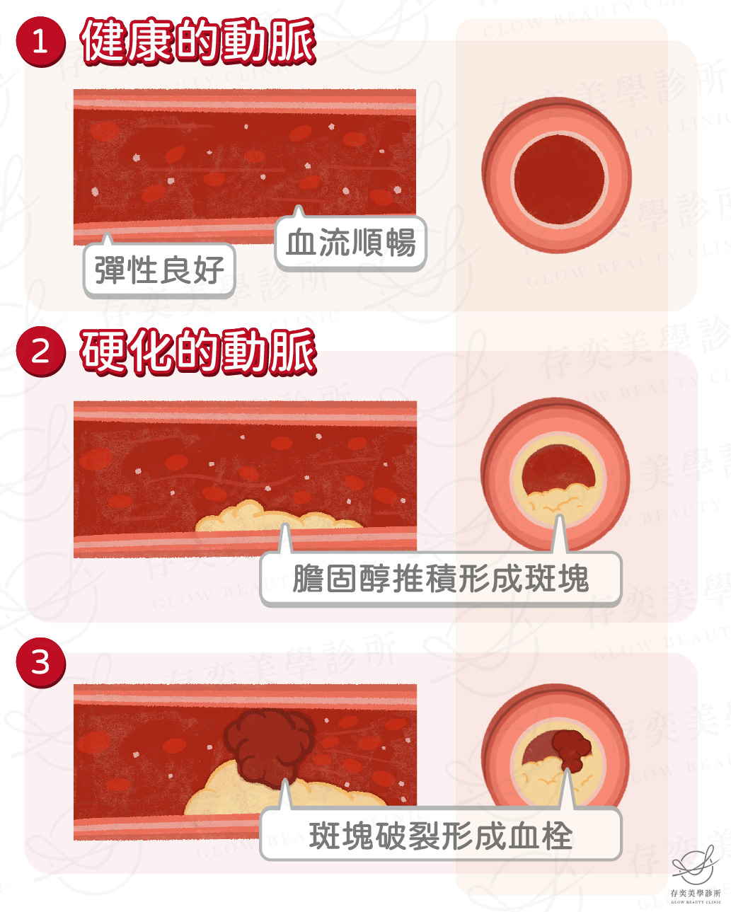 血管硬化是什麼3-03