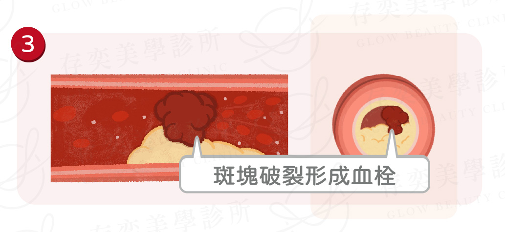 血管硬化是什麼4_斑塊血栓