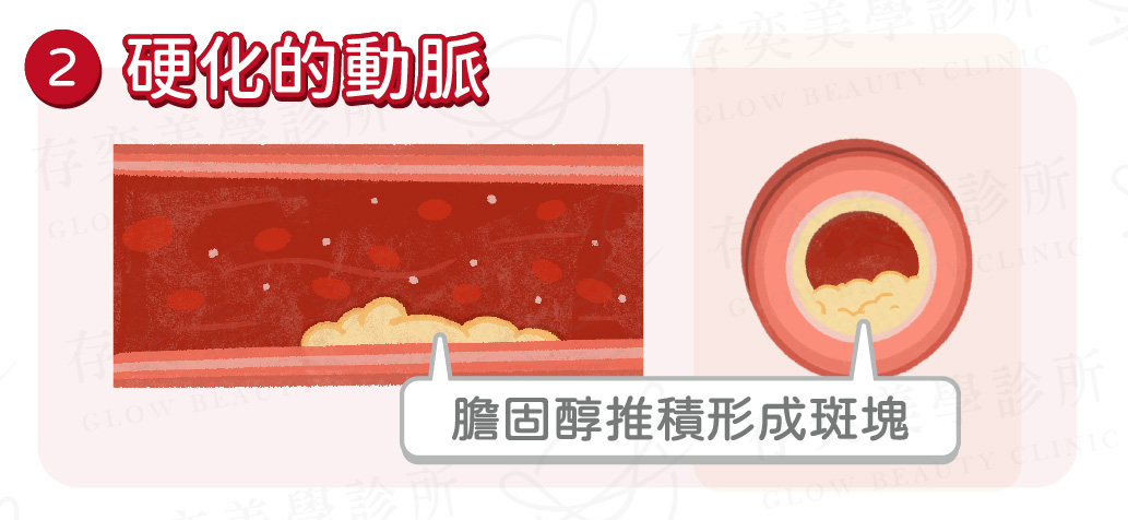 血管硬化是什麼4_硬化的動脈