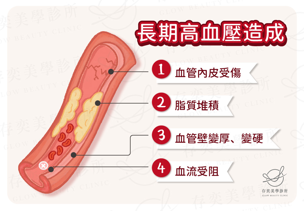 血管硬化4種原因-長期高血壓6_0