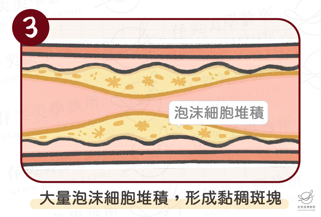 血管硬化4種原因-高血脂-03