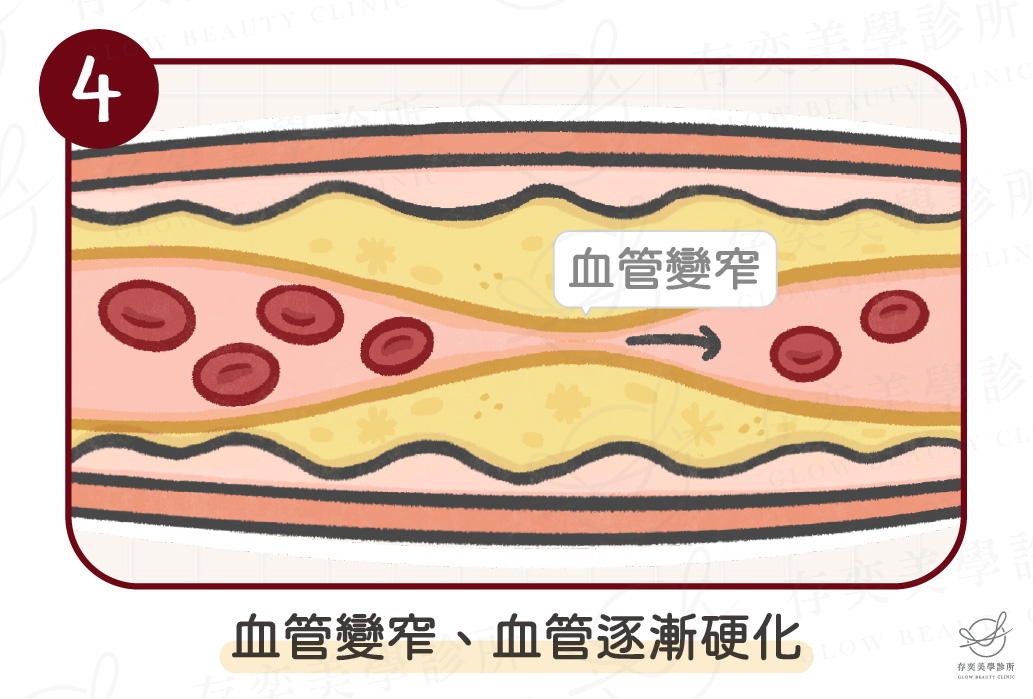 血管硬化4種原因-高血脂-04