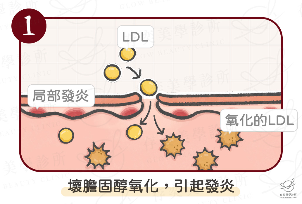 血管硬化4種原因-高血脂_0