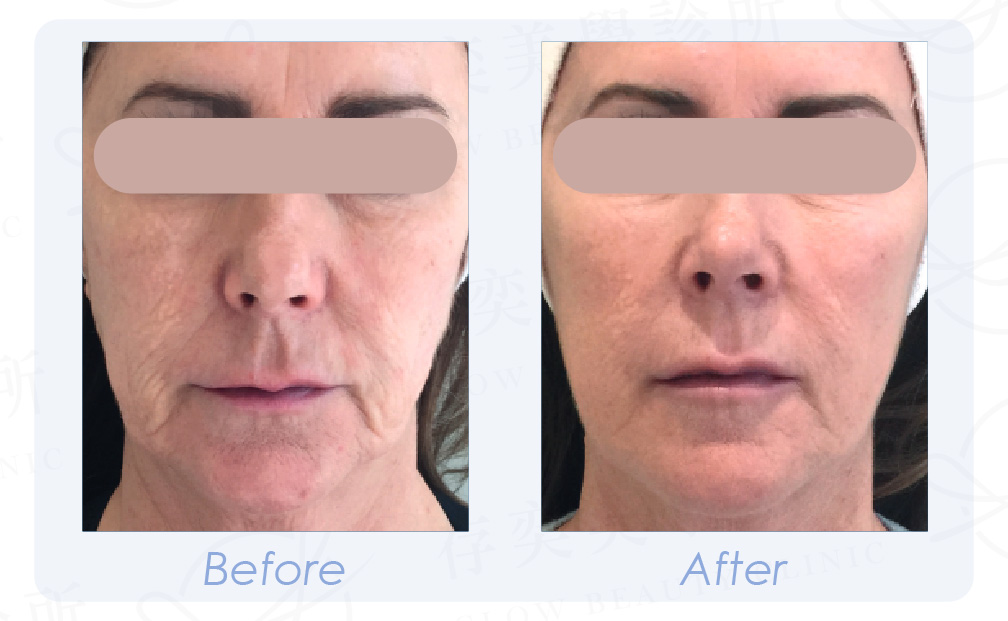 PROFHILO逆時針 BA-03