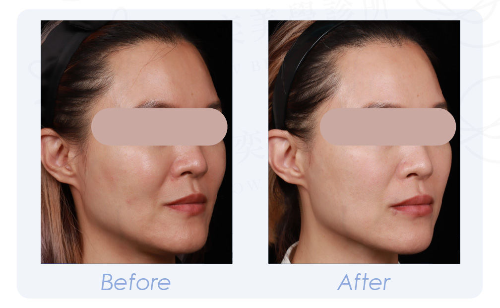 PROFHILO逆時針 BA-09