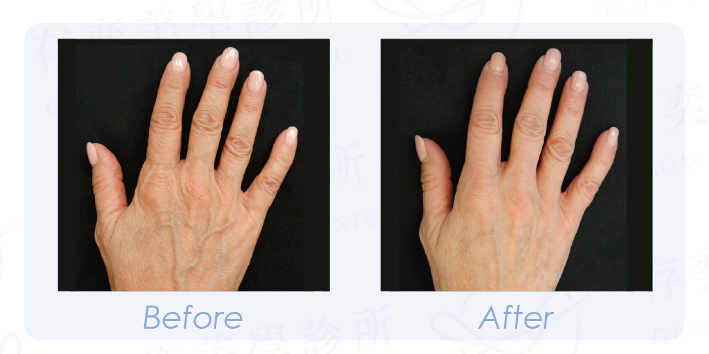 PROFHILO逆時針 BA-11