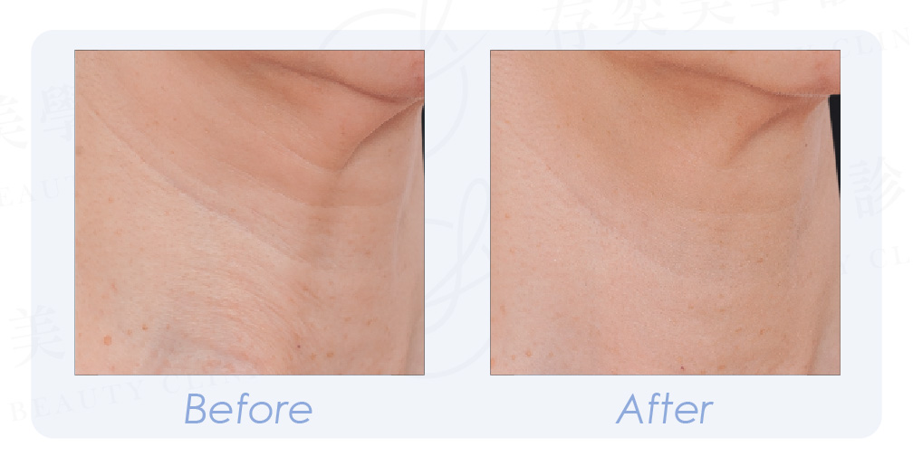 PROFHILO逆時針 BA-12