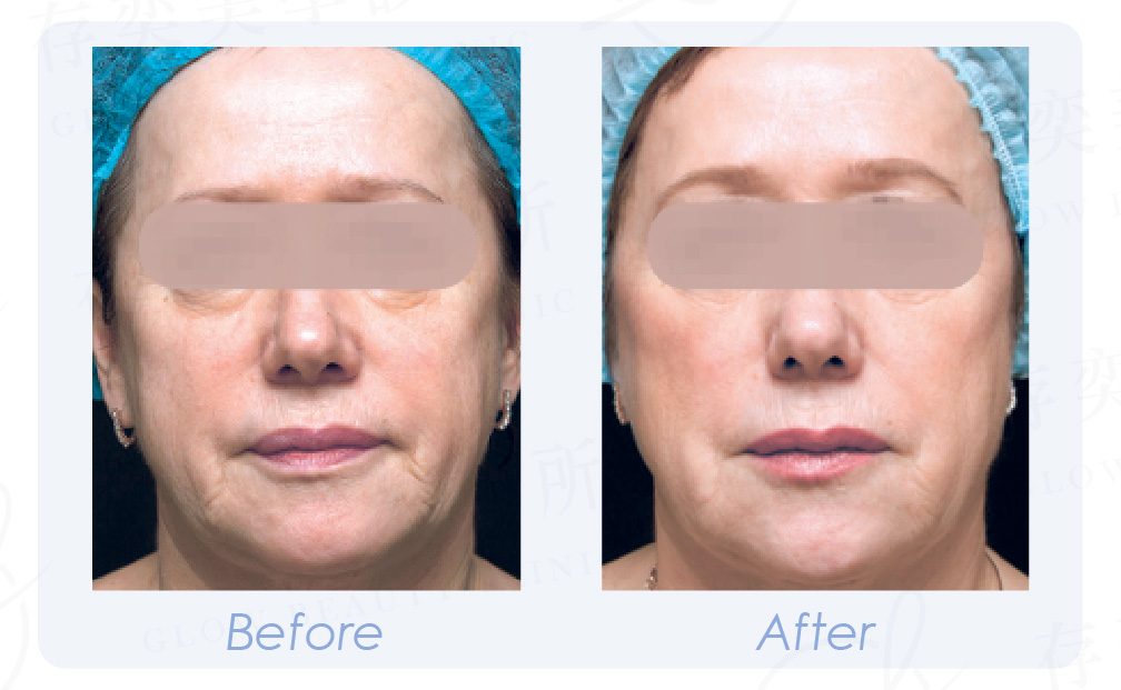 PROFHILO逆時針 BA_工作區域 1