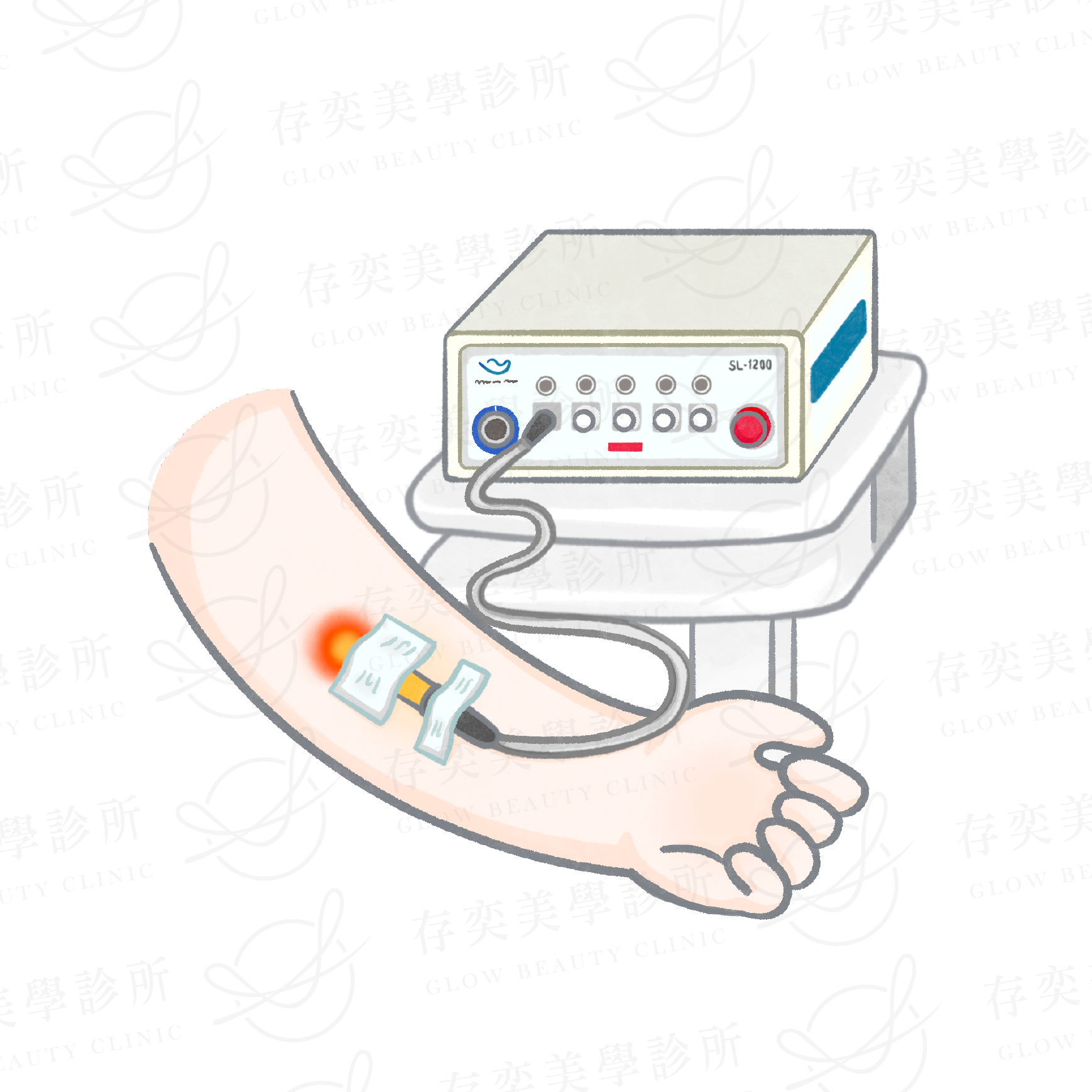 ilib靜脈雷射治療中