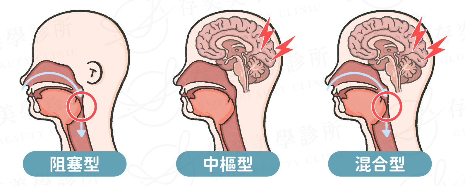 三種睡眠呼吸中止症-01