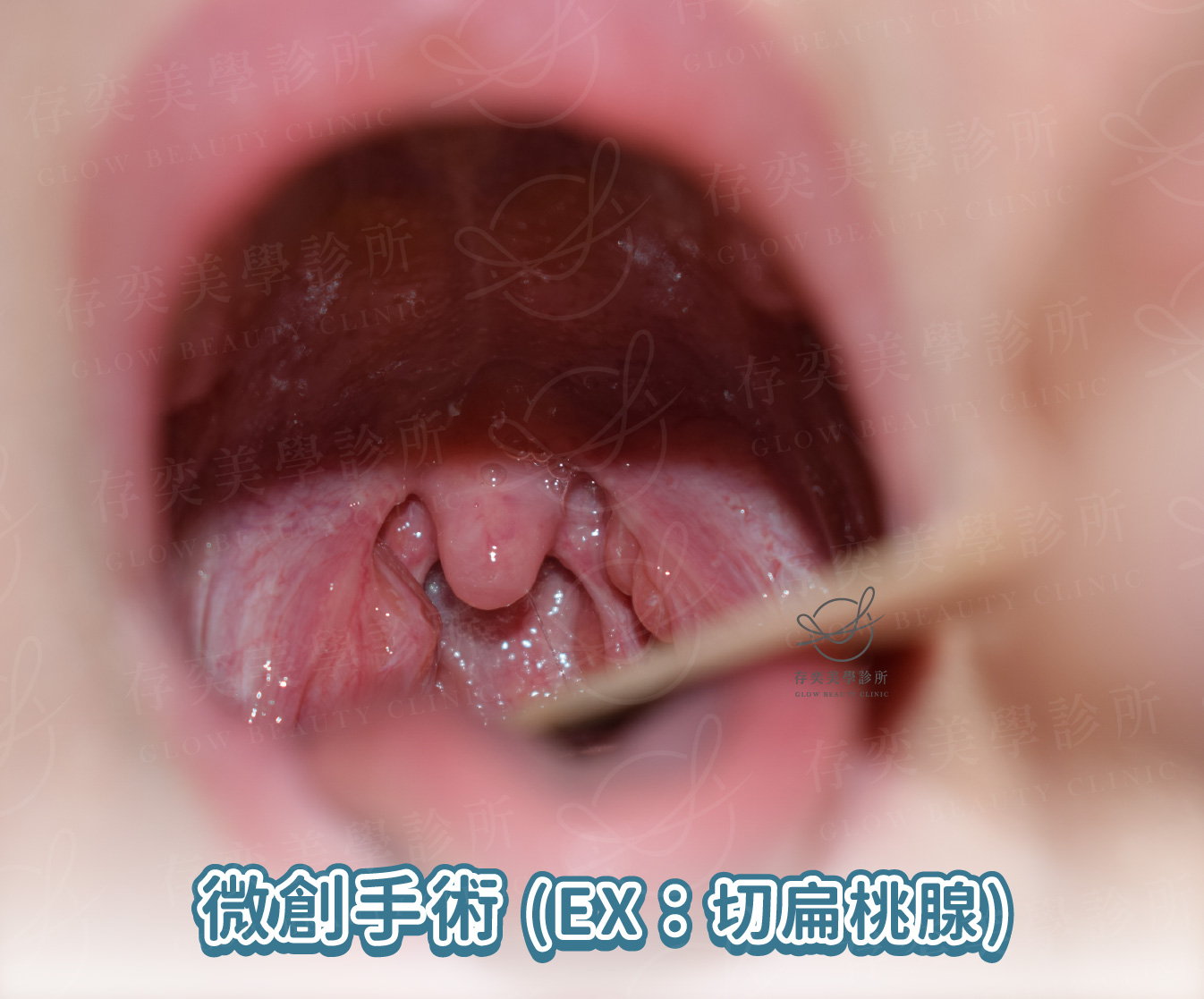 打呼很大聲怎麼改善v2_結構形狹窄手術或侵入性治療