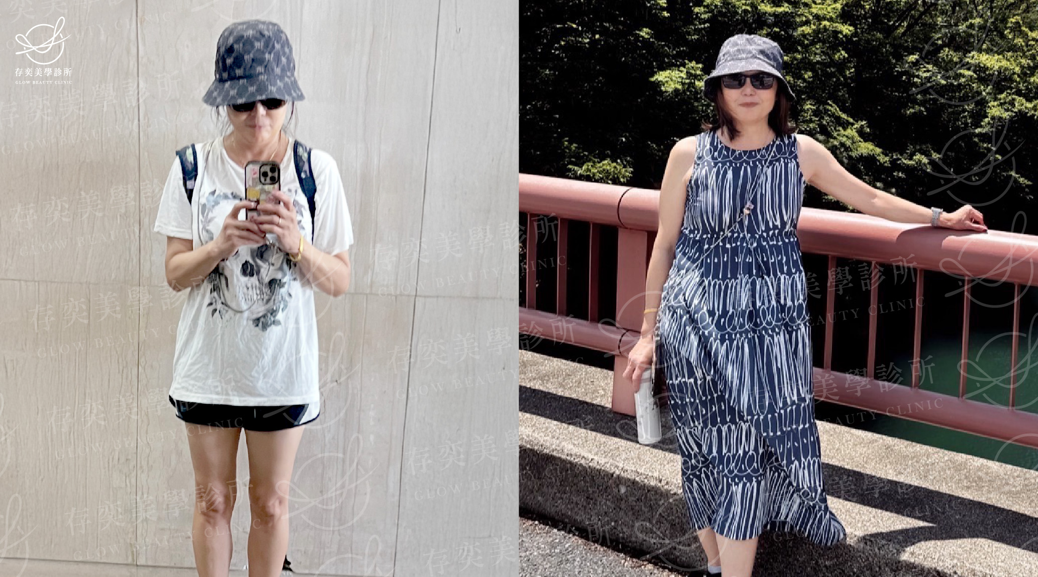 顏安綺減重_術後生活照