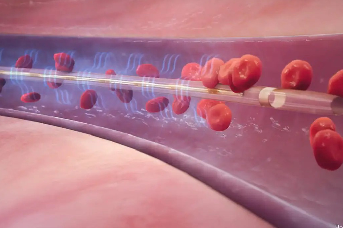 血栓治療方式_血栓手術或導管治療